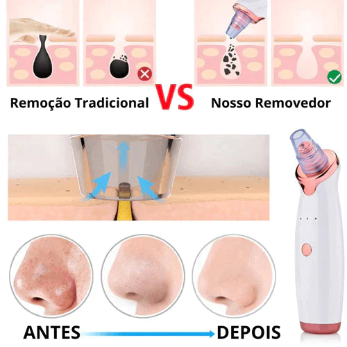 PerfectSkin® - Aparelho de Sucção Removedor de Cravos e Espinha